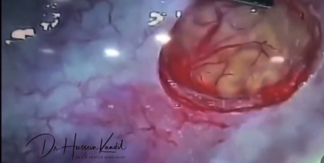 MESA: surgical exposure of the epididymis.