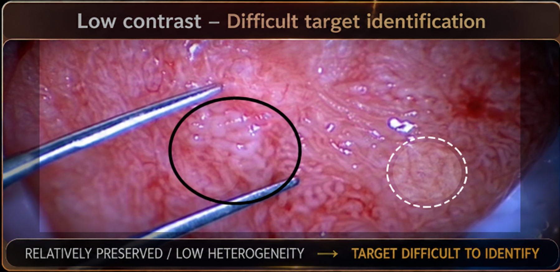 Dilated tubules highlighted between the forceps tips.