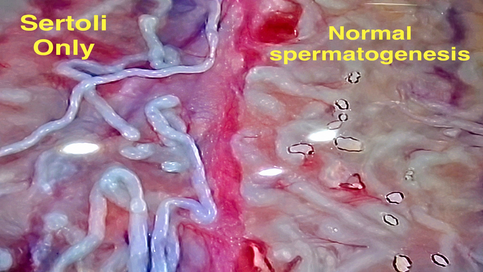 Contrasting tubule appearances in Dr. Hussein Kandil’s teaching image. Laboratory examination confirms sperm production.