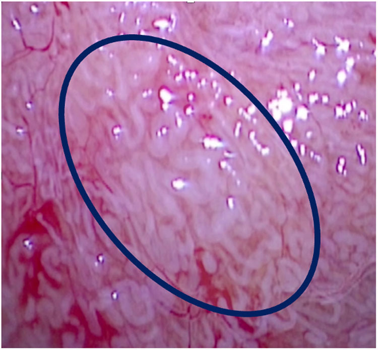 Microscopic view of the seminiferous tubules during microTESE.