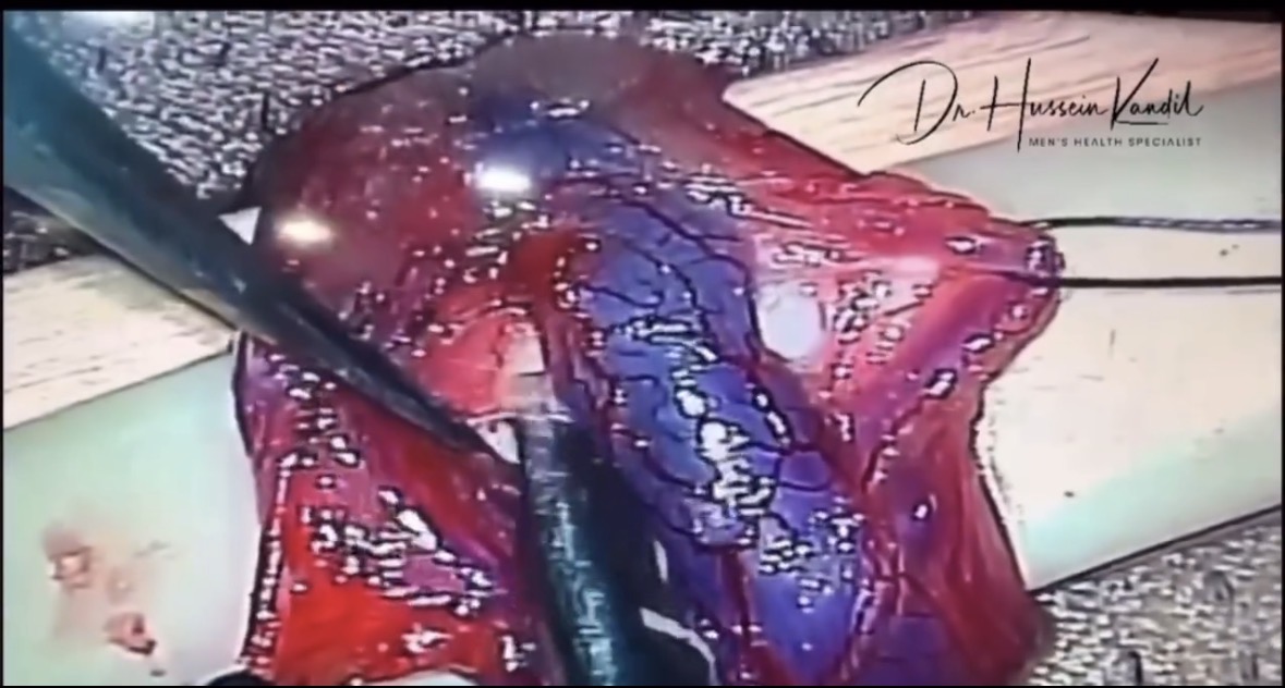 Microsurgical dissection from the original operative sequence.